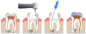 endodontics or root canal procedure